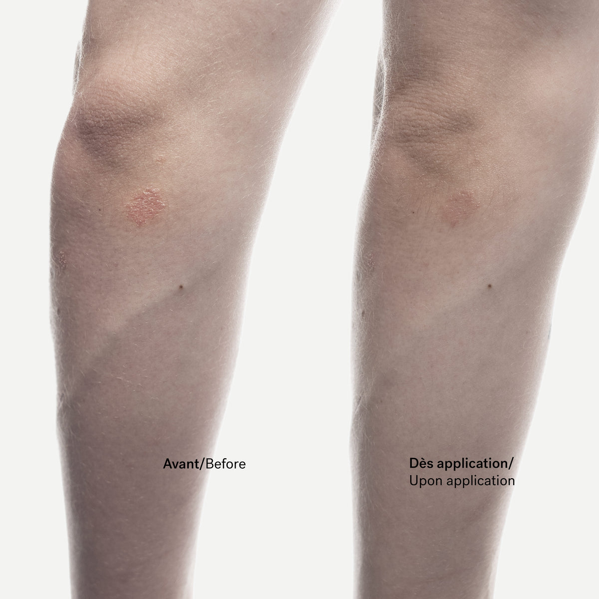 Dry Patch Relief Cream 1% Phytosterols + Allantoin — Typology